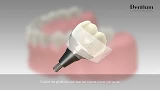 Dentium Customized Abutment