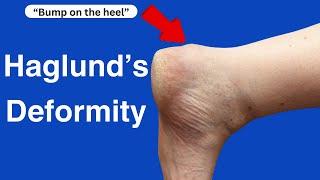 Haglund's Deformity