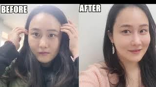 40대 실리프팅 후기
