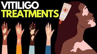 Doctor explains VITILIGO TREATMENT OPTIONS | Phototherapy, excimer laser, steroids & more