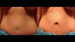 Umbilicoplasty (Belly Button) Surgery | Dr. Derek Lou | Houston, TX