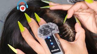 Most Itchy Scalp Ever? 🫣 | Flakes, Crust, & Gentle Scratch ASMR #528
