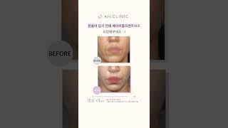 나온 입과 새겨진 팔자주름? 맑을아 입가 전체 베이비콜라겐주사로 교정해보세요 :) #입가주름 #치마주름 #고양이주름 #상어주름  #팔자주름 #팔자필러 #팔자콜라겐주사 #콜라겐주사