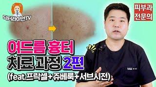 여드름 흉터 레이저 치료 피부과 다운타임 없는 치료 과정 후기 2편 (feat. 프락셀+쥬베룩+서브시전)