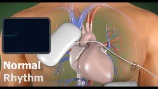 AED - 3D Medical Animation