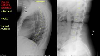 Introduction to Spine Radiographs