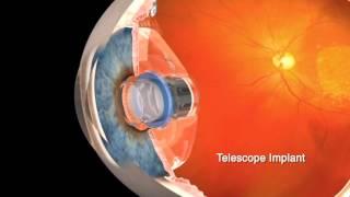 How it Works: The CentraSight Implantable Miniature Telescope