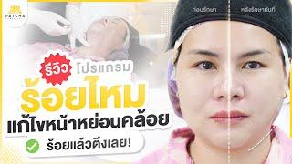 รีวิวร้อยไหม แก้ไขหน้าหย่อนคล้อย