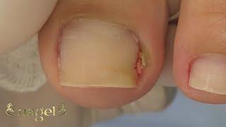 ESPÍCULA EM UMA REGIÃO DE PUS SECO #satisfying #nails