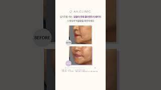 입가주름 개선, 맑을아 전체 콜라겐주사 패키지 그 명성과 탁월함을 확인하세요!  #입가노화 #베이비콜라겐 #자가진피재생술 #입가재생 #입가리프팅
