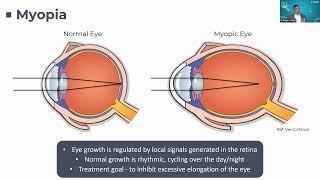 How does being outdoors prevent the development of Myopia? (11 June 2024)