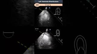 Congenital Left Ventricle Diverticulum & Aneurysm