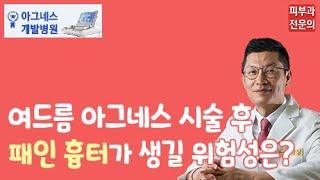 여드름 아그네스 시술 후 패인 흉터가 생길 가능성은?