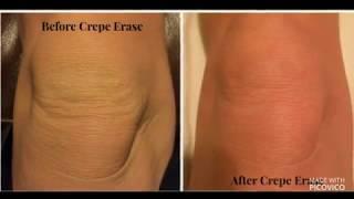 #buy_now #Crepe Erase Crepe Erase Reviews : | Updated 2018 | Crepe Erase Cream