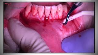 Gingival Augmentation - Tunnel Technique 2 - Mucoderm Dermis (Botiss) by Dr Bernard Dahan