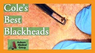 Cole's Best Blackheads Removed | Auburn Medical Group