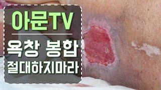 욕창 봉합 절대하지마라 (욕창 수술 치료 피판술 아문성형외과)[아문TV]