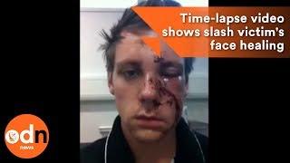 Incredible selfie time-lapse video shows slash victim's face healing