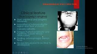 ENT lecture 4th yr 9-4-2020 Neck space infections