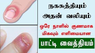 நகசுத்தி ஒரே நாளில் குணமாக எளிமையான வைத்தியம் | How to Cure Nail Fungus Naturally | Naga suthi