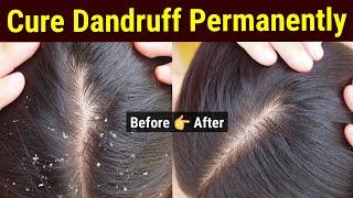 Dandruff Treatment At Home | Dandruff Removal At Home | Dandruff Home Remedy | Anti Dandruff