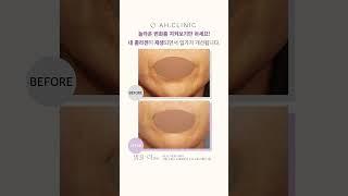 콜라겐 주사로 입가주름이 개선되는 놀라운 변화를 지켜보기만 하세요!