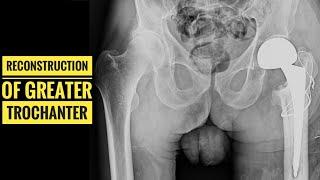 Greater Trochanter Reconstruction with Cercelage wire in Hip Hemiarthroplasty, THR and Revision THR