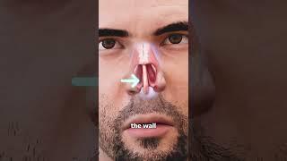 Picking Your Nose Can Cause a Hole 