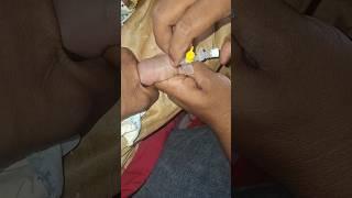 iv cannulation motivation video,#love #motivation #viralvideo #mbbs