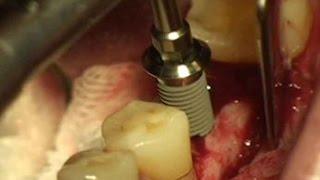 Simple implantation using Dentium Simpleline II on lower posterior region