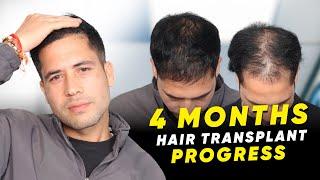 Hair Transplant in Bangalore | Best Results & Cost of Hair Transplant in Bangalore