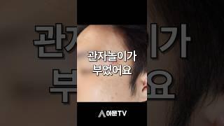 관자놀이가 부어버린 이유는?(성형외과 관자놀이 표피낭종 피지낭종 핀홀법 수술 흉터)[아문TV]