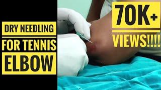 Dry Needling for Tennis Elbow