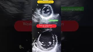 Normal and weak heart echo l हार्ट इको #echo #dcmp #ef #shorts