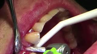 Zirconia One Piece Implant Placement (Z)