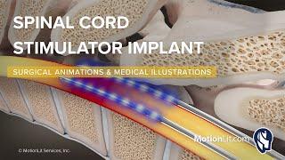 Powerful SCS Implant Animation Drives Multimillion-Dollar Verdicts and Settlement Success