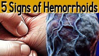 5 signs and symptoms of Hemorrhoids  and treatment