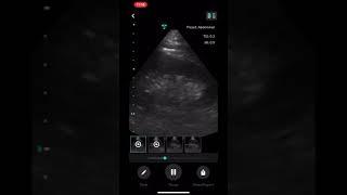 How to Use the Vave Health Ultrasound App