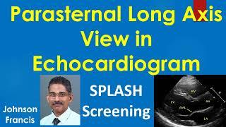 Parasternal Long Axis View in Echocardiogram and SPLASH Screening for RHD