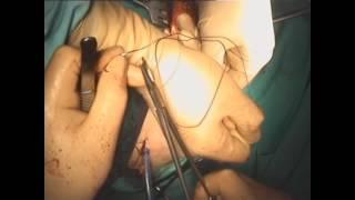 ThuLEP performed simultaneously with open nephrectomy and bladder stones, Dr.Farid Gadimaliyev
