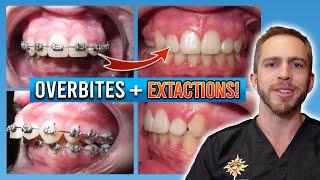 Braces Overbite Treatment! [BEFORE & AFTER]