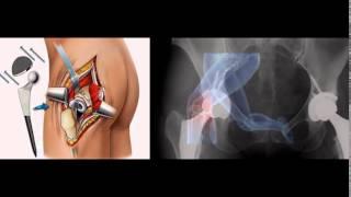 Dr Tejas Gandhi - Elderly Total Hip Replacement Surgeon/Hospital In Ahmedabad, Gujarat