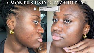 I USED TAZAROTENE FOR 2 MONTHS | TAZAROTENE VS TRETENOIN