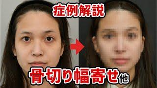 【半年経過写真あり】骨切り幅寄せを含む症例を解説します！！【鼻整形】@logicbeautyclinic