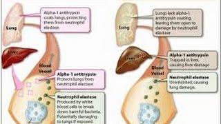 alpha 1 antitrypsin deficiency