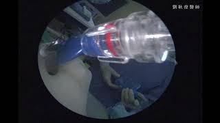 耳咽管阻塞的簡易內視鏡氣球擴張術 E-tube Balloon Tuboplasty