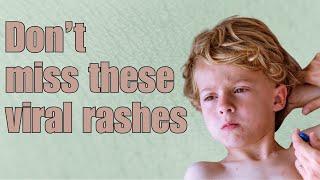 Understanding Viral Rashes: Causes, Symptoms, and Treatment Part 2