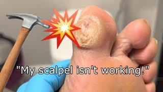 Tackling Painful Hemorrhagic Calluses | Foot Care Tips by Dr. Binh 