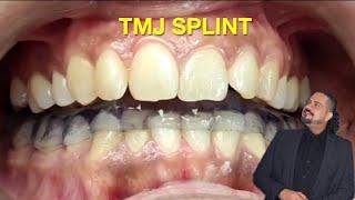 Michigan TMJ Splint #tmd #tmjpain #tmjdisorder #tmjtreatment