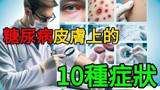 🩺 糖尿病皮膚上的10種症狀 